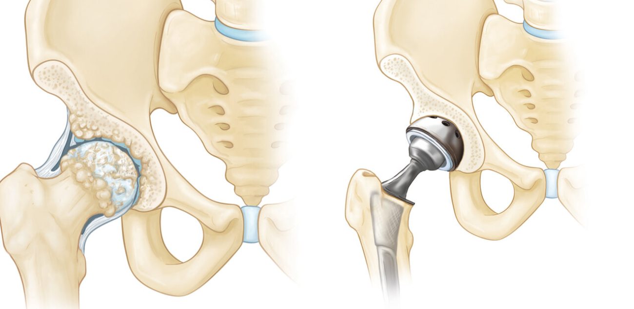 joint-replacement