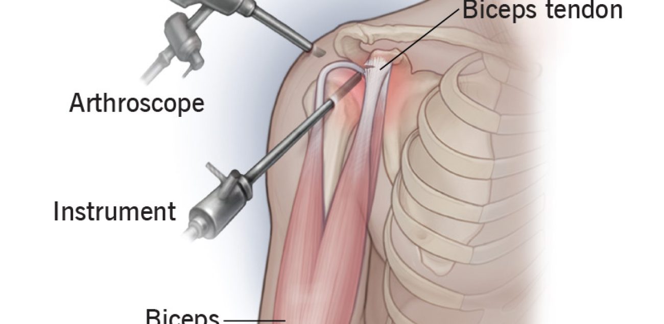 shoulder-arthroscopy